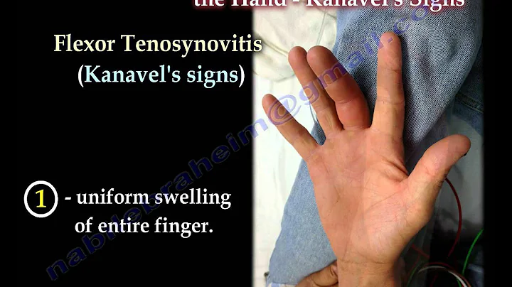 Flexor Tenosynovitis Of The Hand Kanavel's Signs - Everything You Need To Know - Dr. Nabil Ebraheim