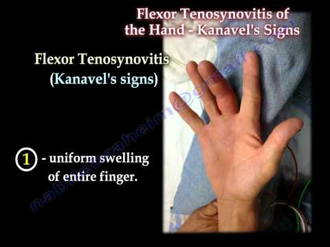 Flexor Tenosynovitis Of The Hand Kanavel&rsquo;s Signs - Everything You Need To Know - Dr. Nabil Ebraheim