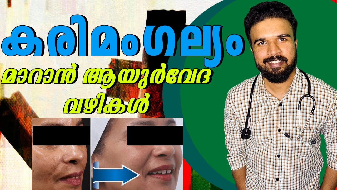 കരിമംഗല്യം  മാറ്റാൻ ആയുർവേദം | MELASMA Treatment | Dark Spots | HYPER PIGMENTATION On Face #melasma