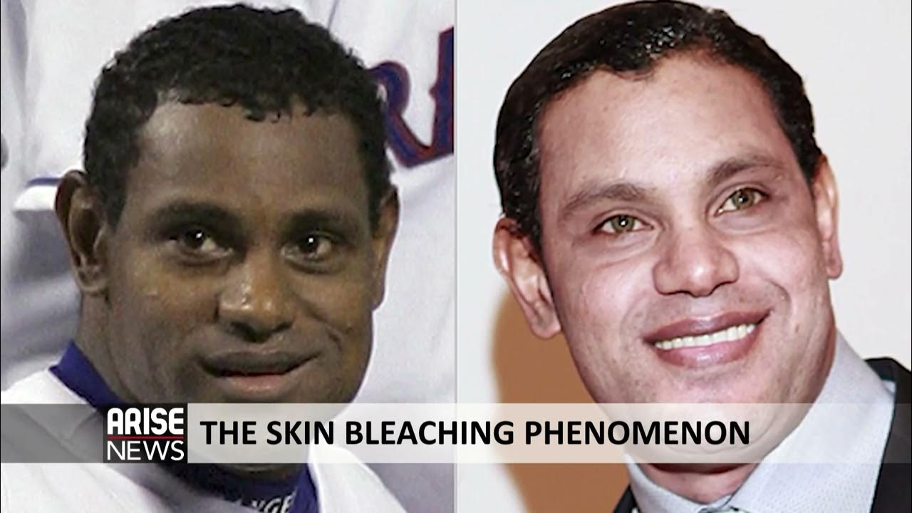 THE SKIN BLEACHING PHENOMENON YouTube