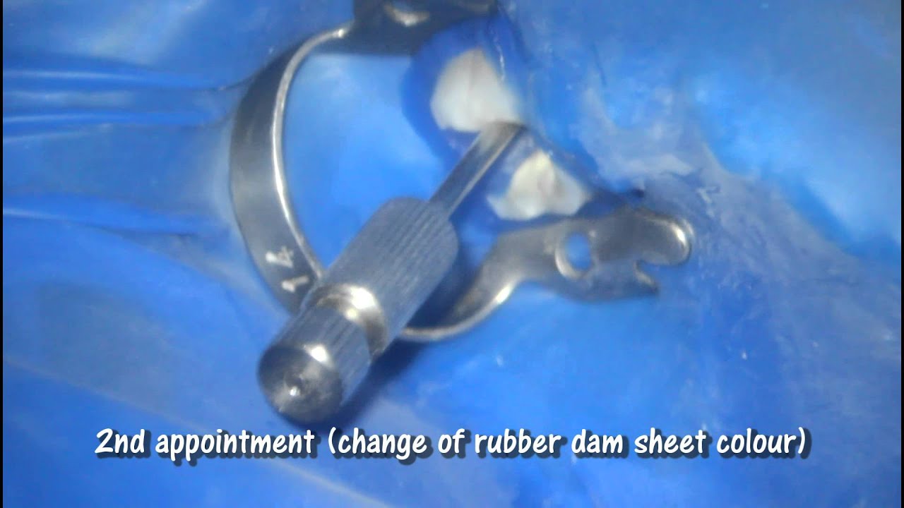 BROKEN INSTRUMENT EXTENDING BEYOND APEX IN ROOT CANAL TREATMENT YouTube