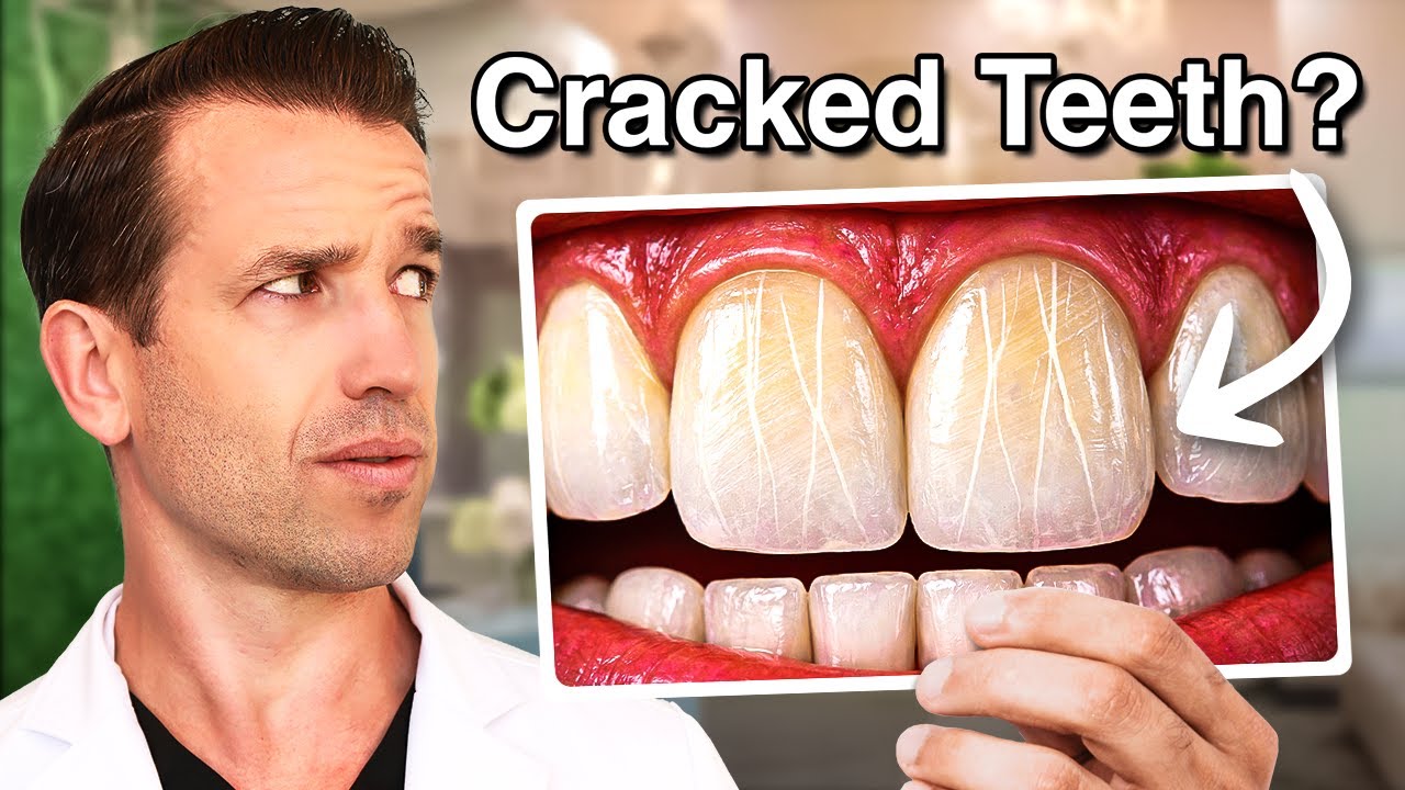 Трещины на зубах | Переломы зубов