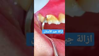 scaling dentistتنظيف الأسنان dentista tartar dentalhygienist fyp foryoupage洁牙