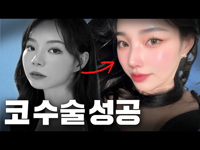 코 수술하고 카리나 된썰 (feat.지방이식)