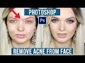 How to Quickly REMOVE Acne/Pimples in Photoshop (Very Easily)