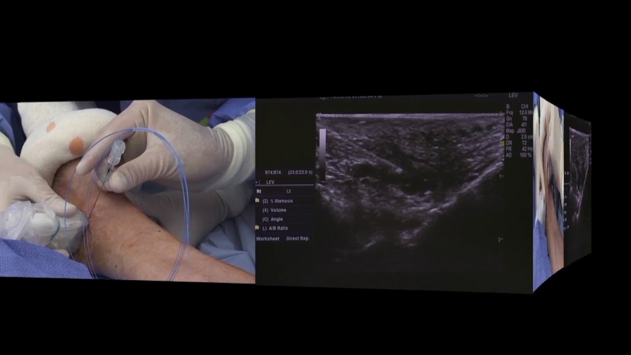 VenaCure Pvak : perforator and accessory vein ablation kit - Société Française de Phlébologie