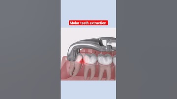 3D animation of molar teeth extraction|wisdom teeth