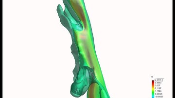 Numerical simulation of Breathing in the Pharynx