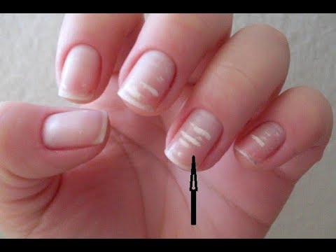 Video: 3 manieren om van witte vlekken op je nagels af te komen