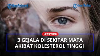WASPADA Inilah 3 Gejala Yang Akan Muncul di Sekitar Mata Akibat Kolesterol Tinggi