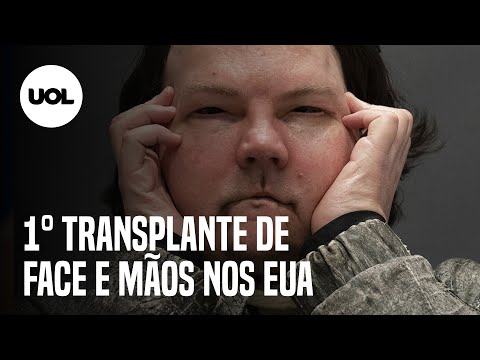 Vídeo: O Primeiro Americano A Fazer Um Transplante De Ambas As Mãos Quer Se Livrar Delas - Visão Alternativa