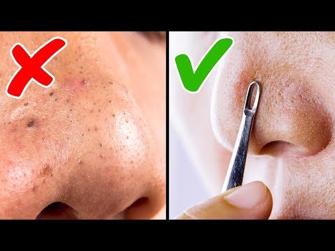 4 Maneras Eficientes De Remover Y Evitar Puntos Negros