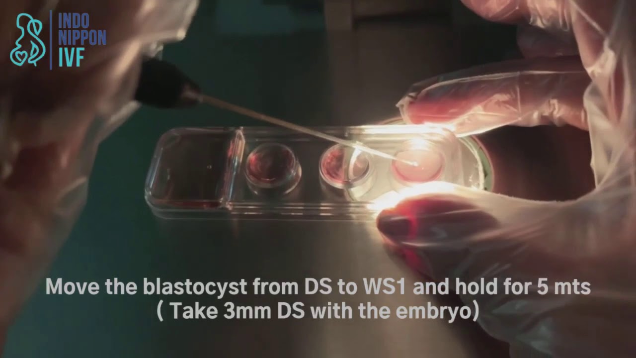 FROZEN EMBRYO TRANSFER AND WARMING OF EMBRYOS BY GORAL GANDHI