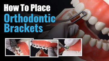 How to Place Orthodontic Brackets | Step by Step Guide for Dentists 🦷