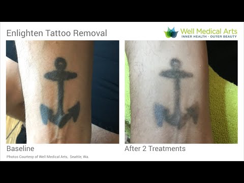 Laser Tattoo Removal Before and After 2 treatments - YouTube
