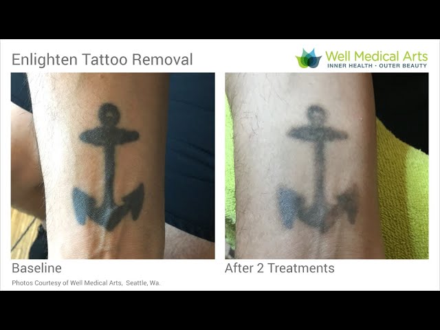 Tattoo Removal  Memphis Tattoo Removal  Dermatology Realm