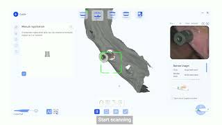 BLZ Dental Intraoral Scanner Scanbody Library Using Guides