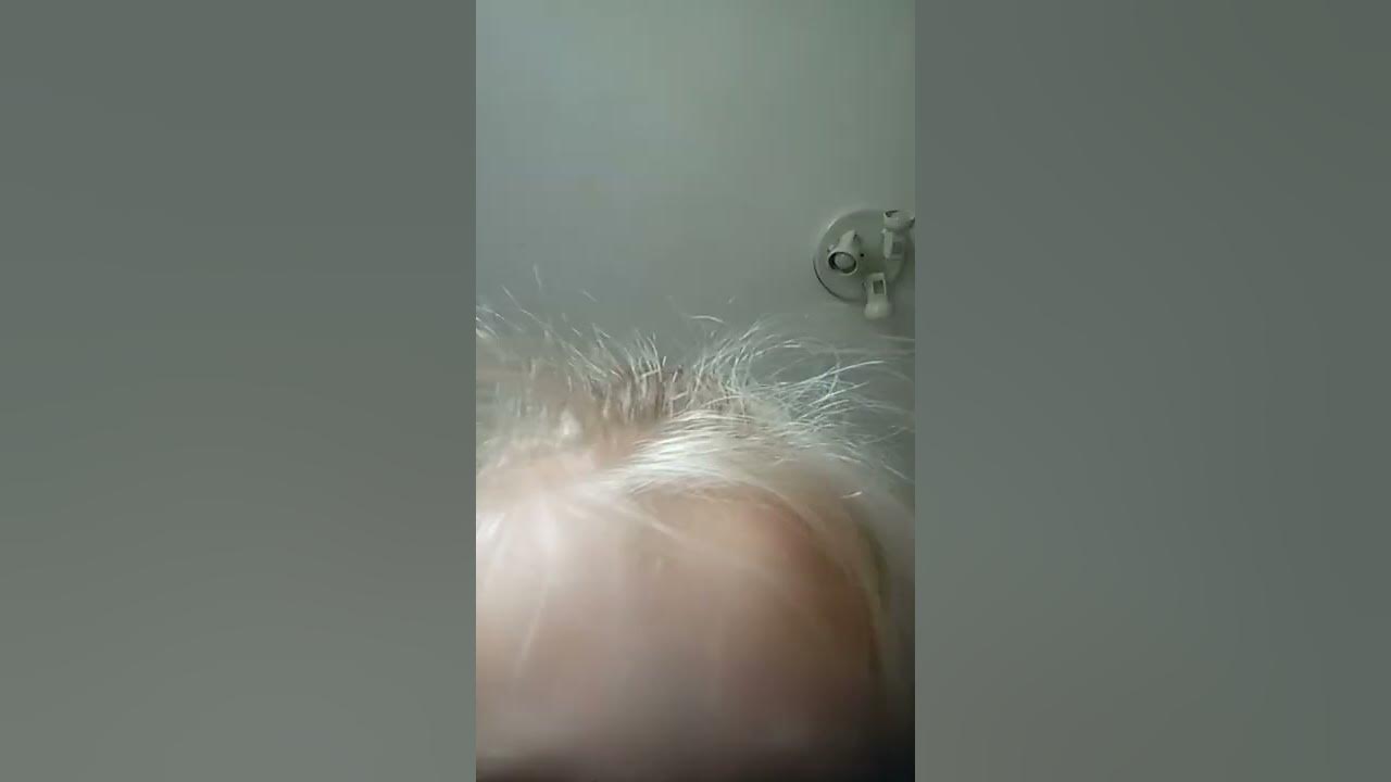 абсцес - YouTube