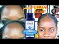 TIKTOK MADE ME USE SHAMPOO TO TREAT THE LITTLE BUMPS ON MY FOREHEAD| FUNGAL ACNE