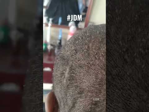 Piojos, liendres en cabeza Más en mi canal, suscribete #Limpieza #Acné #Doctor #Video #Viral