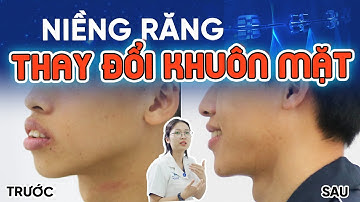 Niềng Răng Có Thay Đổi Khuôn Mặt Không? Kiểm Chứng Ngay Với 6 Ca Niềng Răng Hô - Móm - Khấp Khểnh!