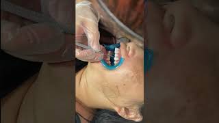 Tooth Filling ::: Cuspid Tooth Extraction ::: Teeth Expander Process ::: Teeth Cleaning  teeth