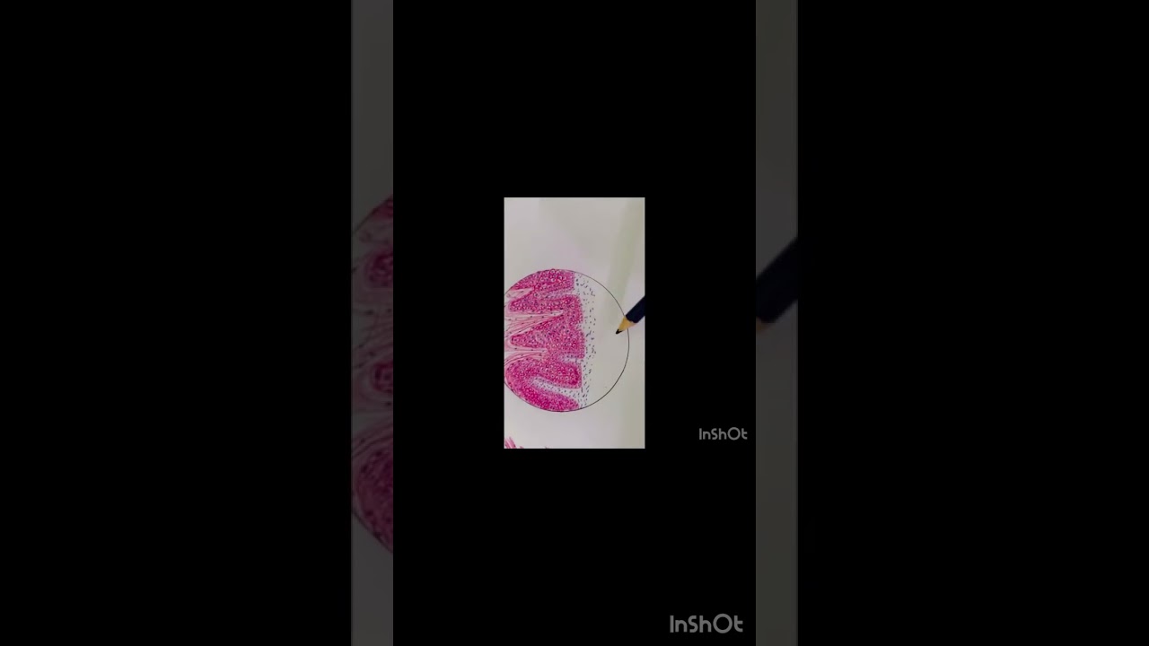 Histopath diagram of Verrucous Carcinoma/ Malignent epithelial Tumors