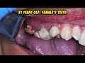 TARTAR CLEAN UP | Dentist | Dokter Gigi Tri Putra