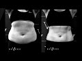 How Much Does CoolSculpting Cost?