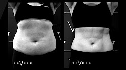 How much does CoolSculpting cost?