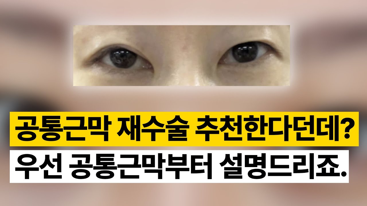 Ганнам Соён гоо сайхны мэс заслын эмнэлэг – Гоо сайхны мэс заслын зөвлөгөө 💌 – Урд булчингийн дүүжлэлт, нийтлэг апоневрозын мэс засал хийлгэж байсан өвчтөн байна...