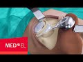 BONEBRIDGE BCI 602 Implant Surgery | MED-EL