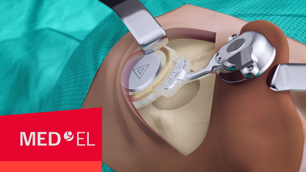 BONEBRIDGE BCI 602 Implant Surgery MED EL YouTube BONEBRIDGE BCI 602 Implant Surgery MED EL YouTube