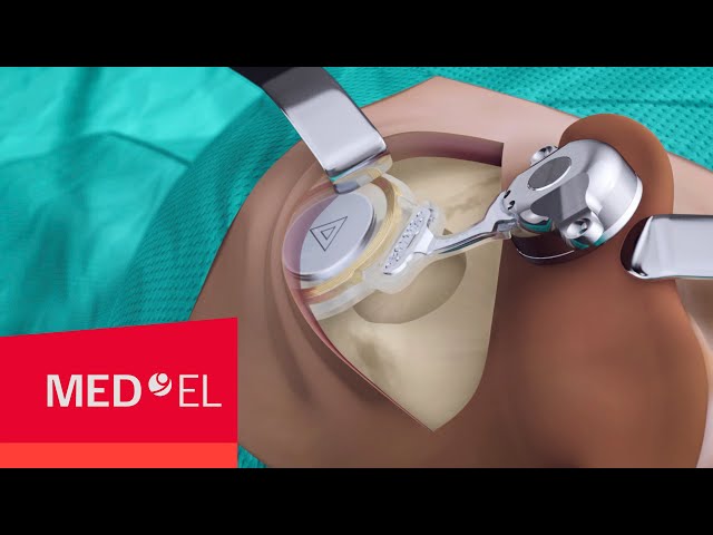 BONEBRIDGE BCI 602 Implant Surgery | MED-EL class=