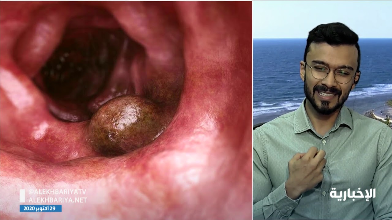 شاب يتغلب على مرض الكرونز بالتحدي والإصرار