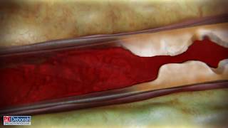 Treating Peripheral Artery Disease