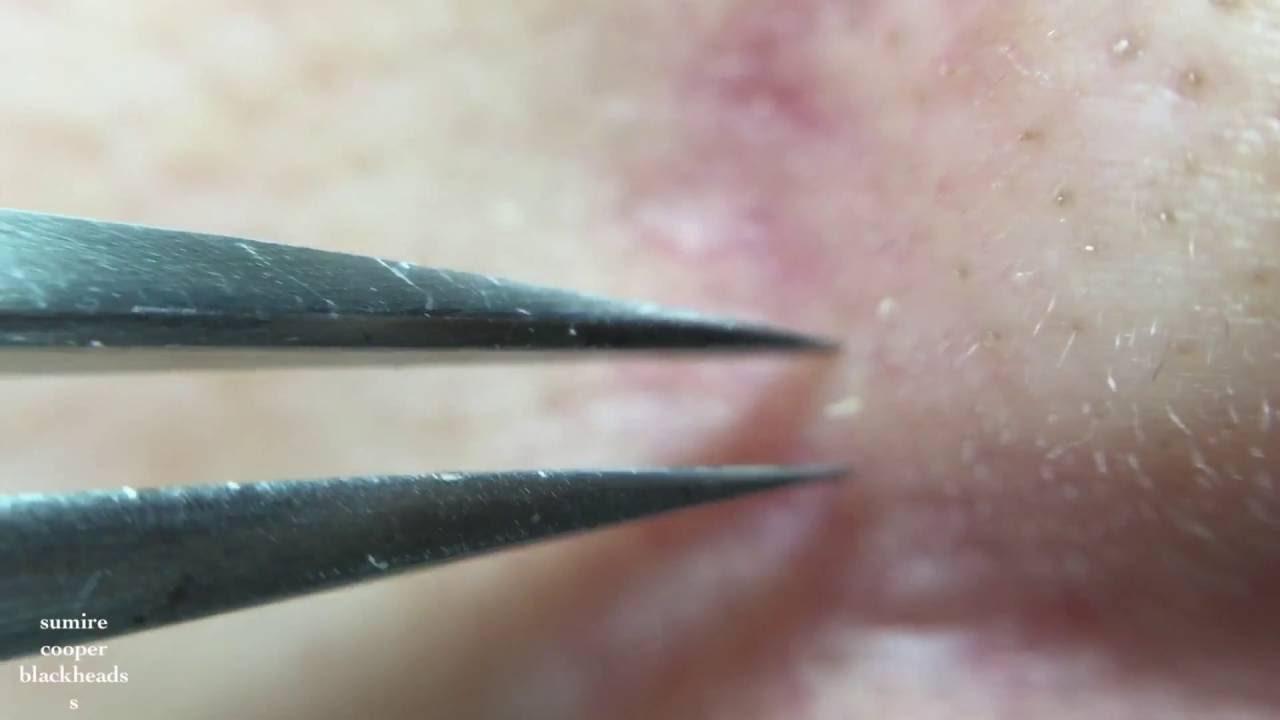 鼻角栓75nose blackheads★Tweezers only★ YouTube