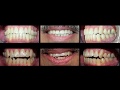 Invisalign to Treat Patients with Openbite at Cosmetic Dental Associates