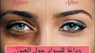 تخلصي من الهالات السوداء بلحظات ……….How to remove dark circles in an Instant