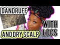 HOW TO GET RID OF DANDRUFF/DRY SCALP WITH LOCS