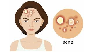 Acne and Blemish Free Face and Body Home Remedy