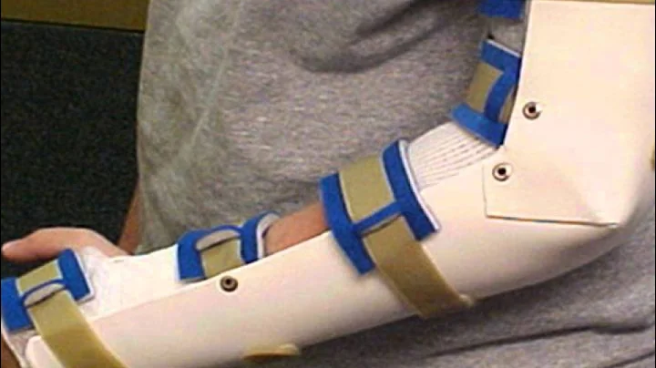 Evaluation and Treatment of TFCC Injuries