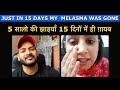 Just in 15 days my 5 years old Melasma was gone. 5 सालो की झाइयाँ 15 दिनों में ही ग़ायब