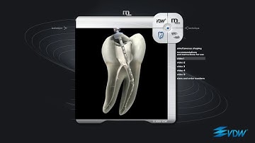 Root Canal Preparation using VDW Mtwo Rotary Files | pinkblue