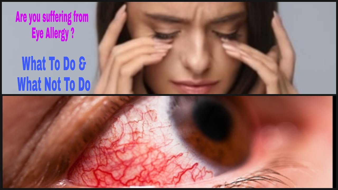 Home remedies for Sore Eyes Sore eyes Symptoms eye drop for Sore