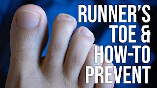 Runners Toe & Silicone Toe Caps for Prevention