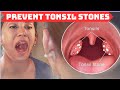 What CAUSES Tonsil Stones and How to Prevent Them