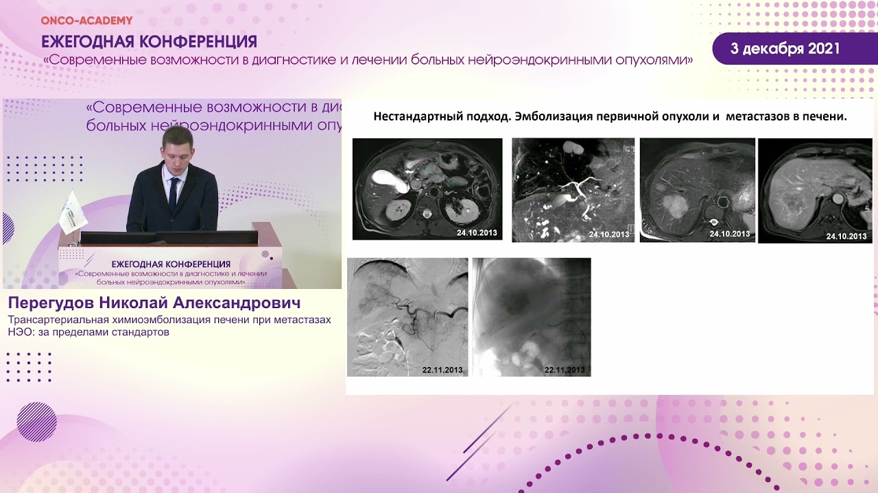 Трансартериальная химиоэмболизация печени при метастазах НЭО: за пределами стандартов.