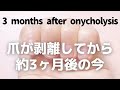 爪甲剥離症、その後。爪が剥離してから約3ヶ月半。about 3 months after onycholysis