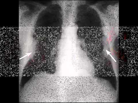 ASBESTOS LUNG CANCER - YouTube